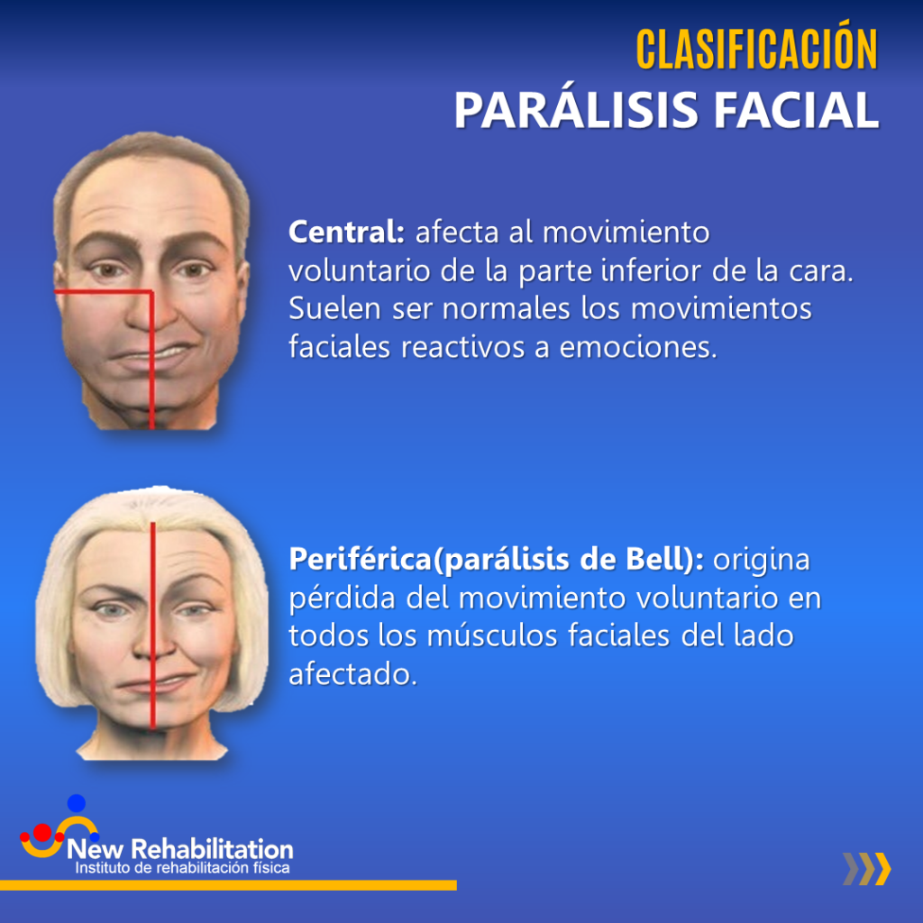 Rehabilitacion Por Paralisis Facial Kulturaupice