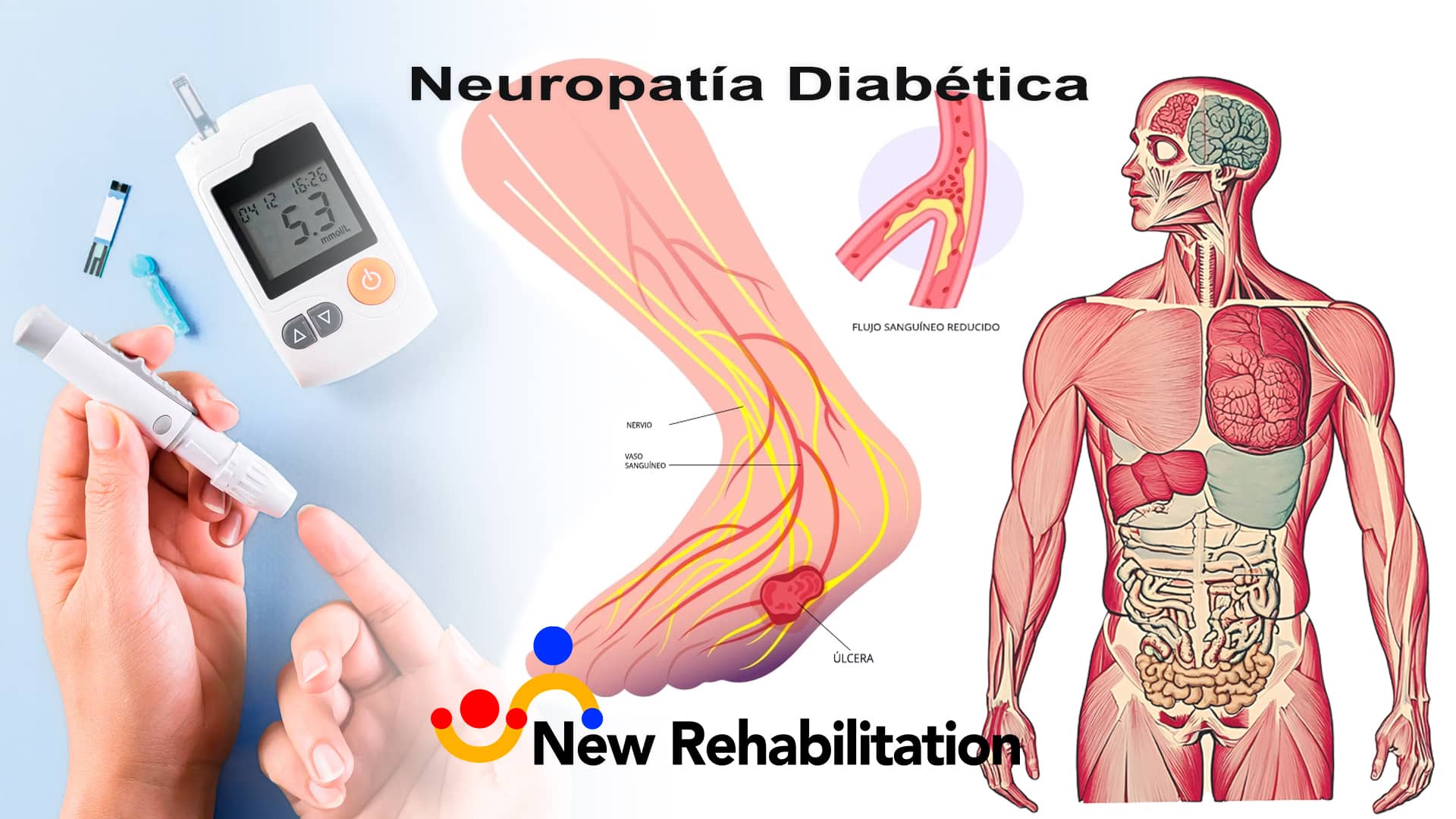 ¿Qué es la Neuropatía diabética?